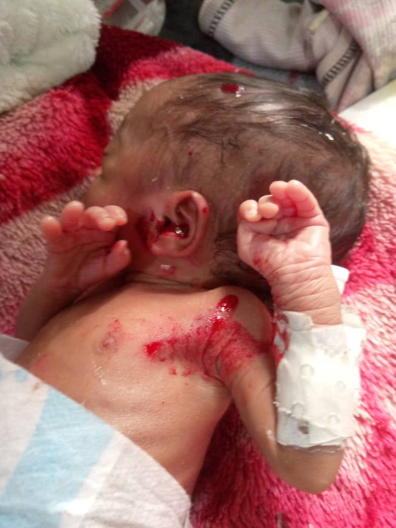 Guerre à l’Est : un bébé touché par une balle perdue dans une couveuse à Goma