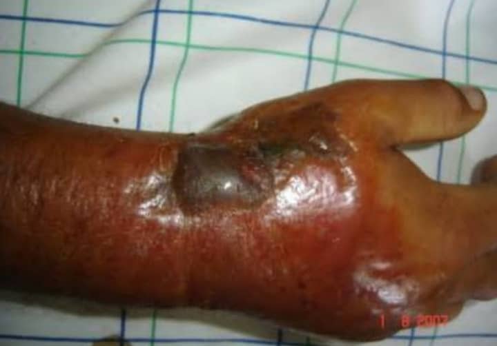 RDC : une nouvelle épidémie d’origine animale dénommée ” Anthrax” frappe le Nord-Kivu