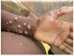 Mpox : Un cas confirmé au Togo